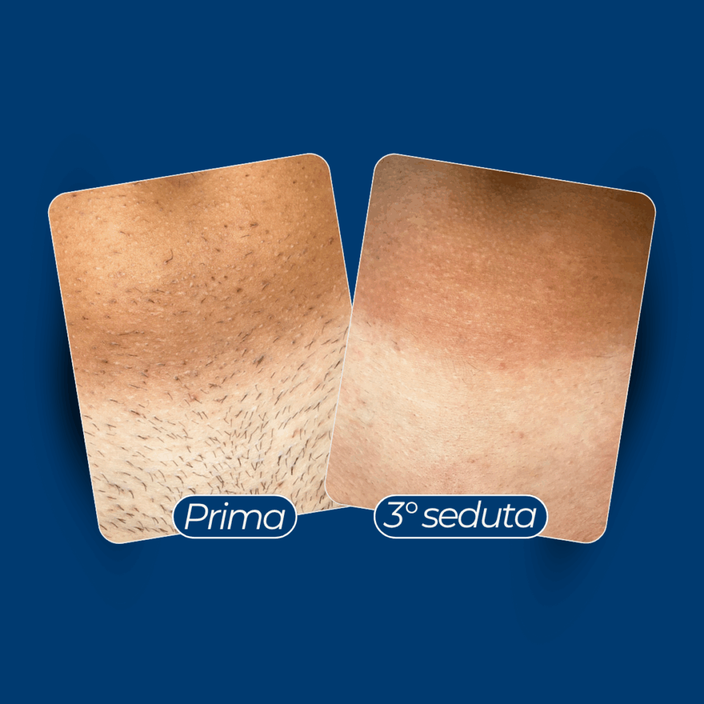 Metodo Remove Epilazione Definitiva Risultati Immediati