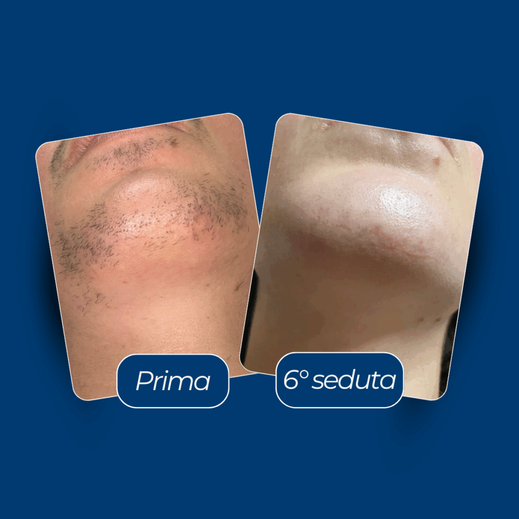 Metodo Remove Epilazione Definitiva Risultati Immediati